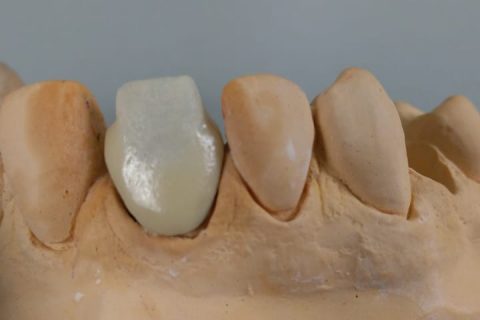 Curso de Metalocerâmica em parceria com a JV Dental