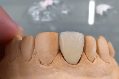 Curso de Metalocerâmica em parceria com a JV Dental