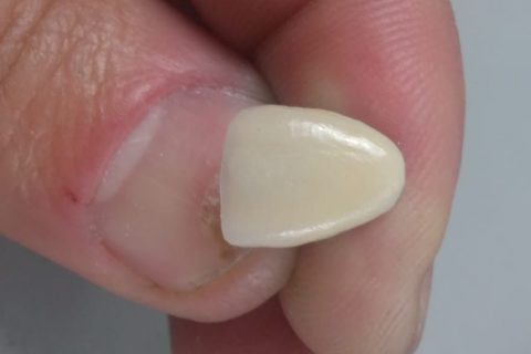 Curso de Metalocerâmica em parceria com a JV Dental