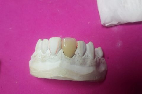 Curso de Metalocerâmica em parceria com a JV Dental